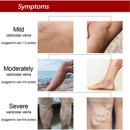 Varicose Veins Treatment Cream