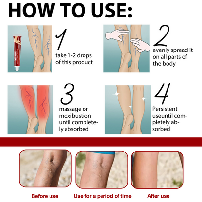 Varicose Veins Treatment Cream