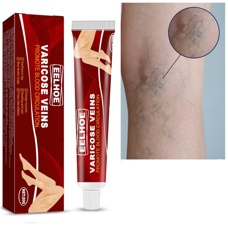 Varicose Veins Treatment Cream